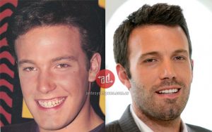 dientes_nuevos_de_Ben-Affleck_www.antesydespues.com.ar