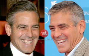 dientes_nuevos_de_George-Clooney_www.antesydespues.com.ar