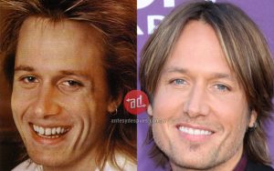 dientes_nuevos_de_Keith-Urban_www.antesydespues.com.ar